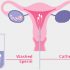 IUI Treatment